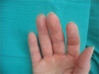raynauds after