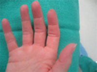 raynauds after