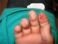 raynauds before