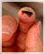 raynauds finger