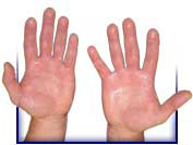 sweating hands