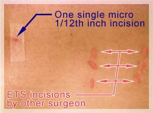 6 ETS incisions
