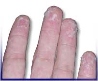 hand skin peeling