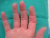 raynauds after ets surgery