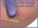 Micro ETS Incision