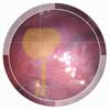 nerve regeneration
