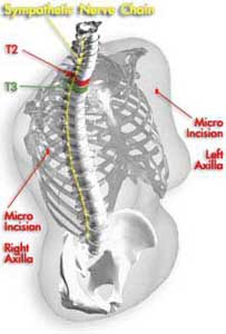 hyperhidrosis incisions